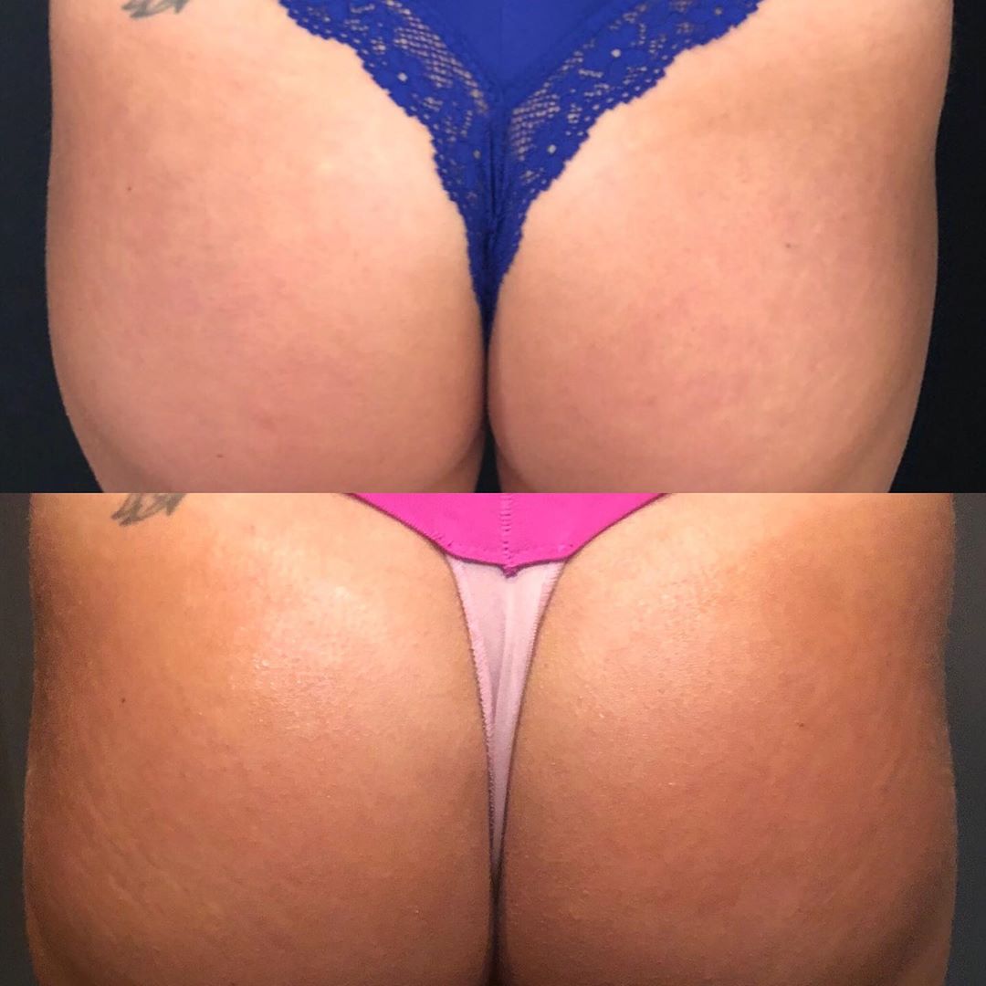 Sculptra | Butt Before & After Images
