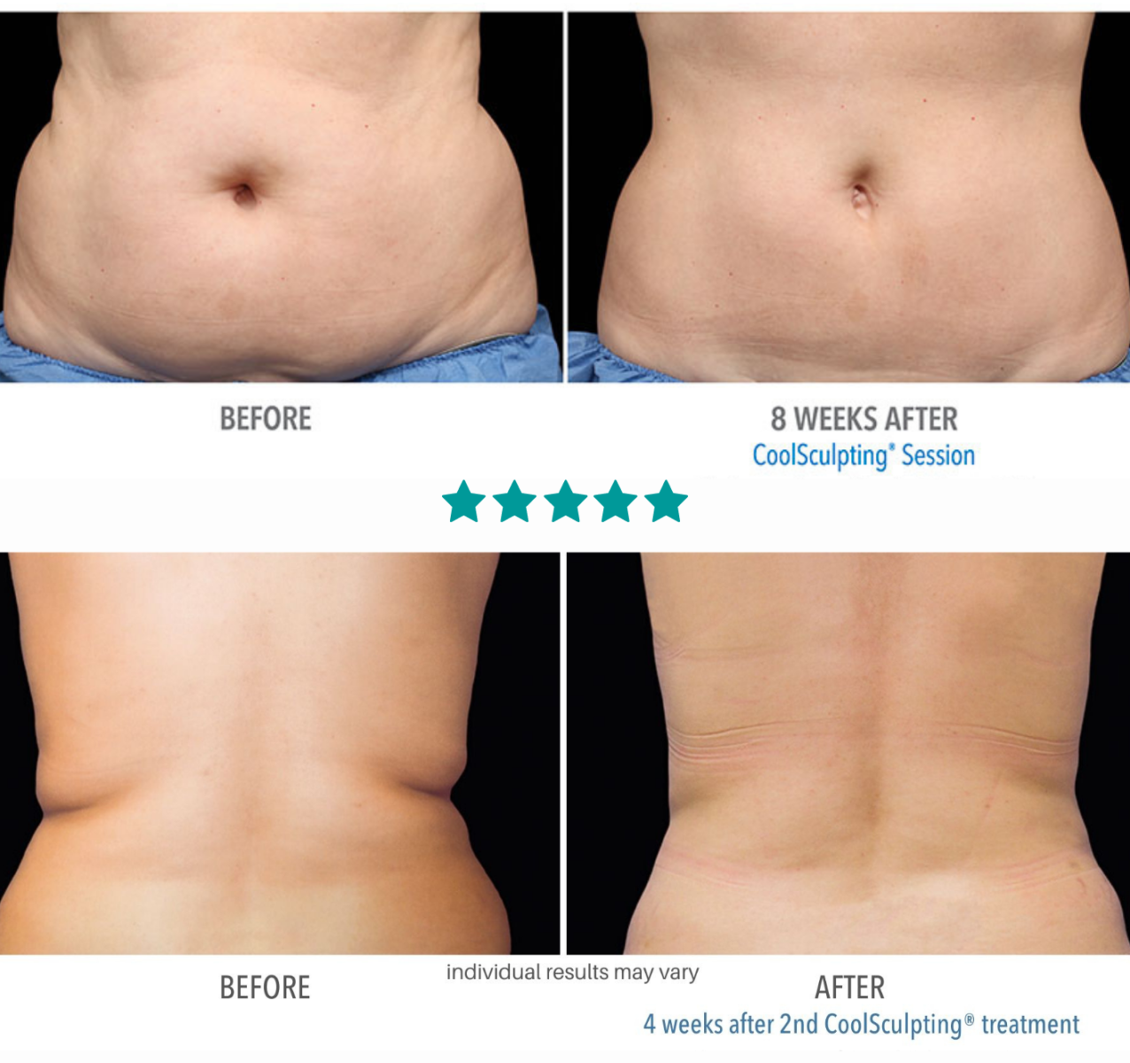 Body Sculpting FAQs: Are CoolSculpting Results Permanent? - The